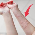 女子一吹空調就全身起疹,癢到發狂!醫生檢查后臉色突變:這不是普通過敏