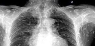 男子「吃魚」全身瘙癢以為過敏!一照X光「整片密密麻麻」嚇傻,醫警告:恐入侵大腦