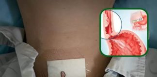 「吞咽困難」警惕食管癌!腫瘤專家:「這3種食物是兇手」無奈很多人卻天天吃!